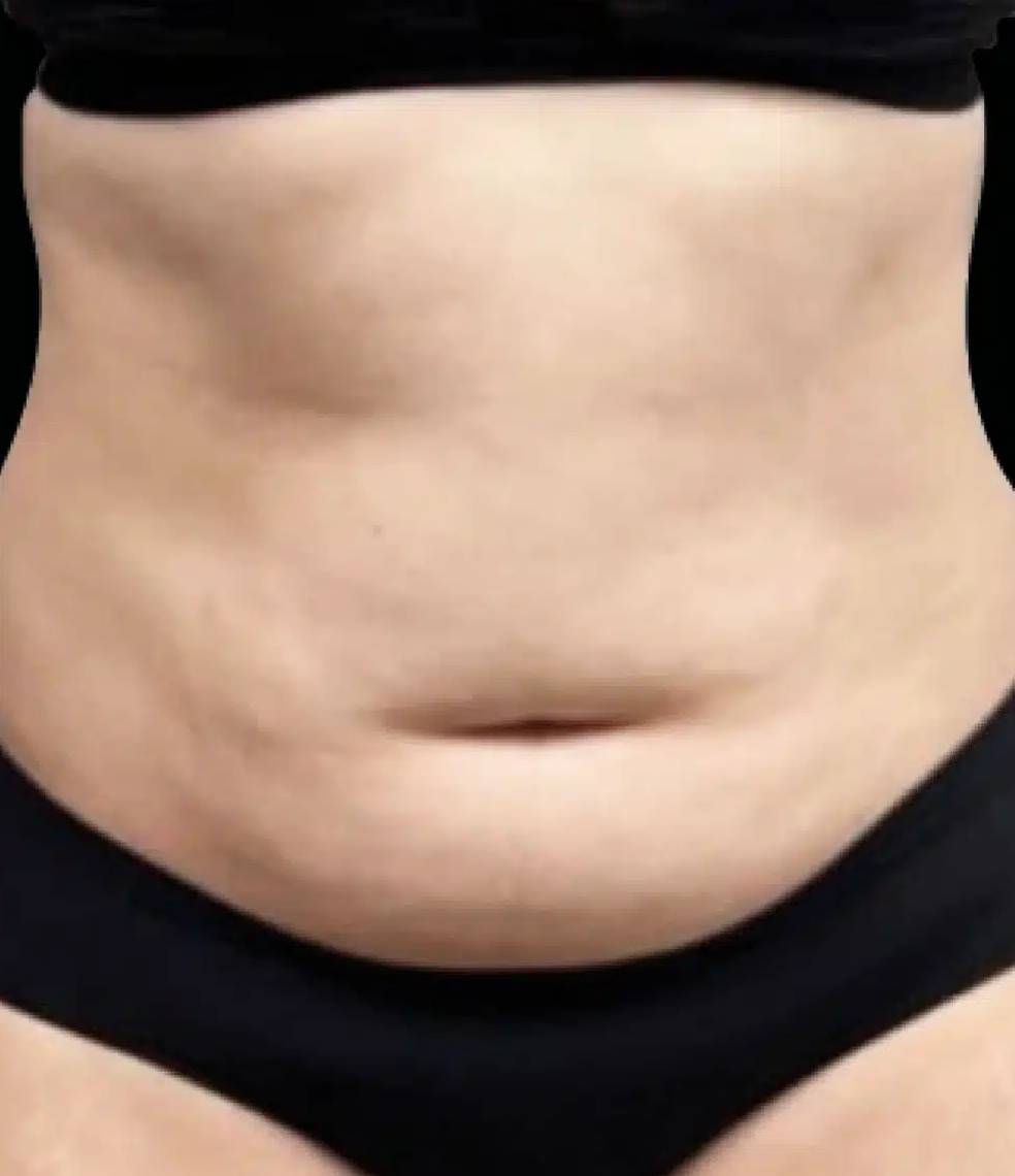 Body contouring, EMSculpt NEO, and fat reduction Dubai